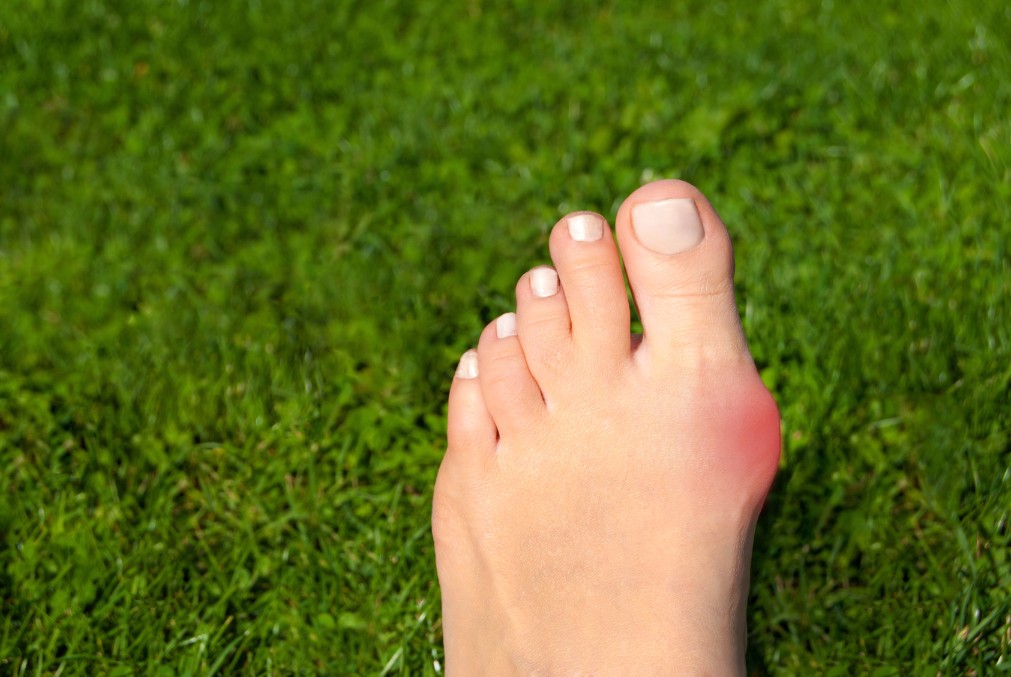 「外反母趾」の原因と症状は？自宅で改善する6つの方法