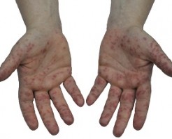 大人もかかる手足口病、原因と対策