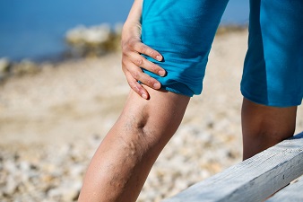 脚の血管がぼこぼこになる下肢静脈瘤の原因と予防